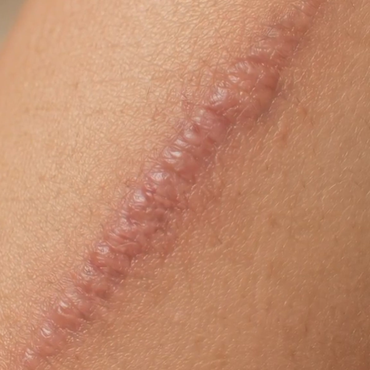 SCAR SILICONE TAPE